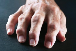 RHEUMATOID ARTHRITIS