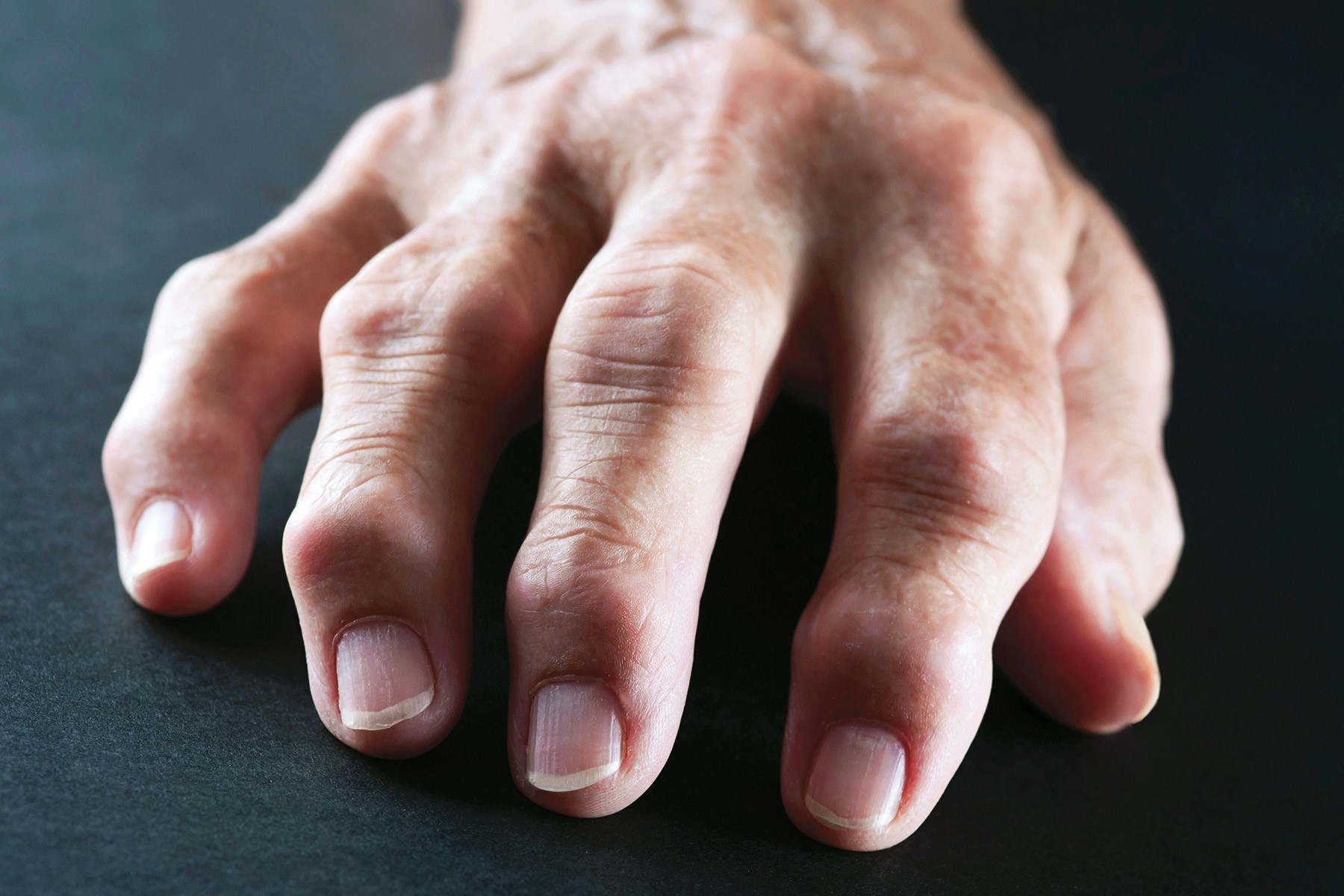 RHEUMATOID ARTHRITIS